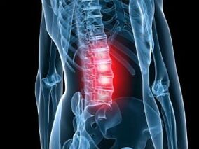 Jostas mugurkaula osteohondroze