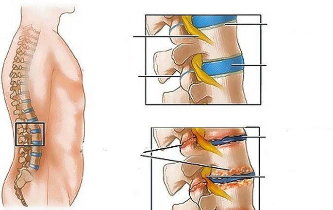 Jostas reģiona osteohondroze