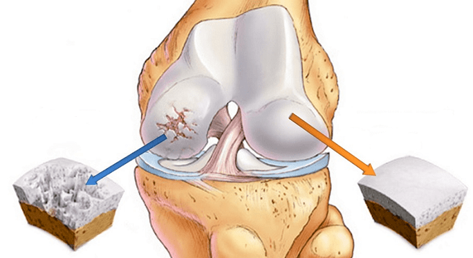 veseli skrimšļi un artrozes skarti skrimšļi