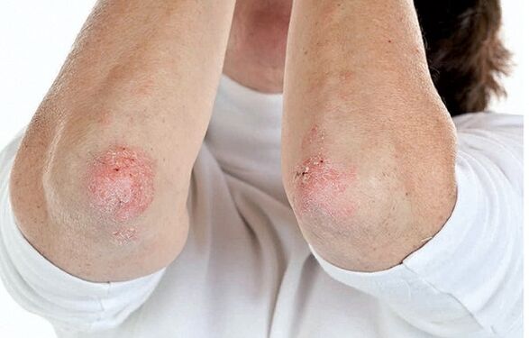Cilvēki ar psoriāzi ir uzņēmīgi pret psoriātisko artrītu
