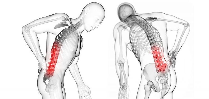 dzemdes kakla osteohondrozes komplikācijas